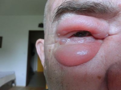 Tři včelí bodnutí.